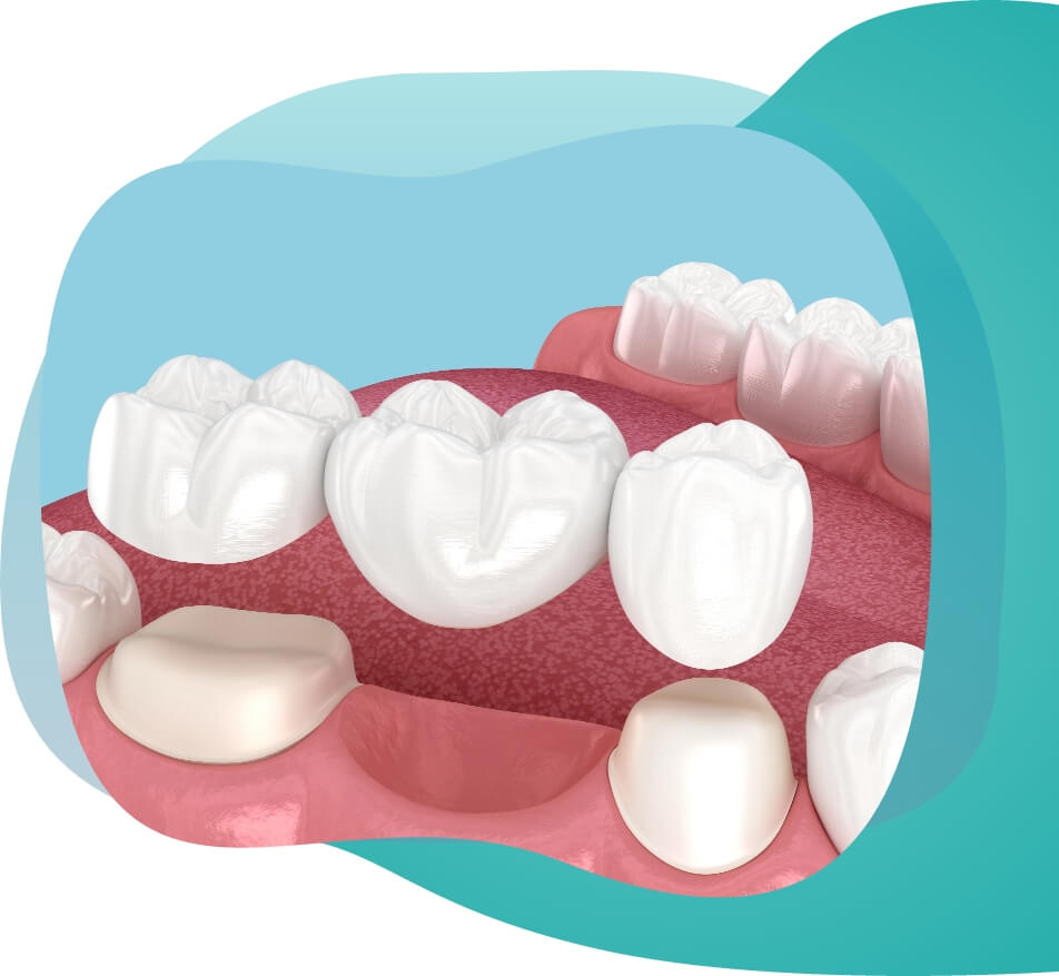 Bridge right for image