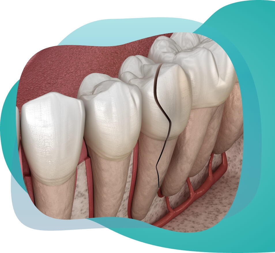 Dental truma image
